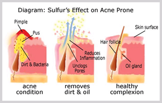Sulfur's Effect On Acne Prone Diagram