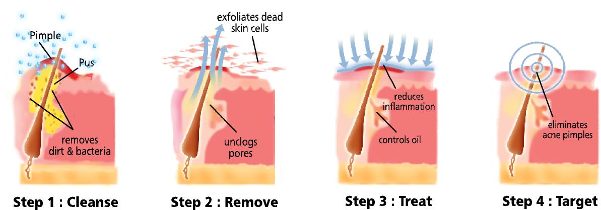 Steps Of Sulfur Effect On Acne Prone